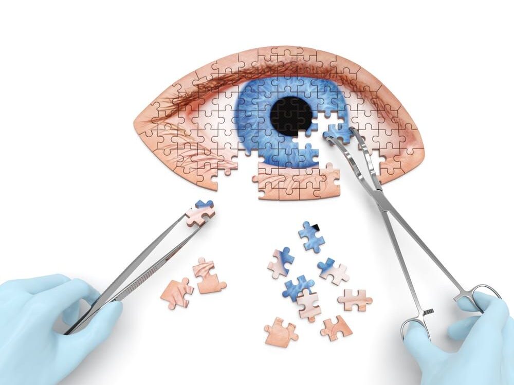 CATARACT SURGERY CATARACT SURGERY