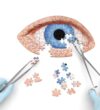 CATARACT SURGERY